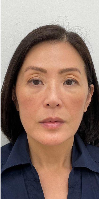 Facial Fillers Before & After Patient #4193