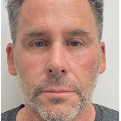 Facial Fillers Before & After Patient #4194