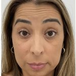 Botox Before & After Patient #4204