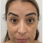Botox Before & After Patient #4204