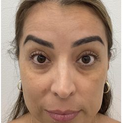 Botox Before & After Patient #4204