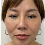 Chin Filler Before & After Patient #4214