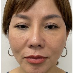 Chin Filler Before & After Patient #4214