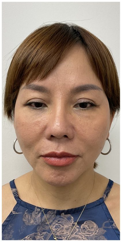 Chin Filler Before & After Patient #4214