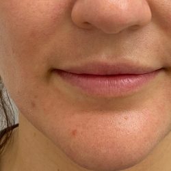Lip Fillers Before & After Patient #4231