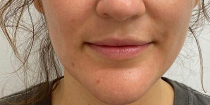 Lip Fillers Before & After Patient #4231