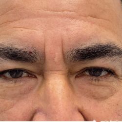 Lower Blepharoplasty Before & After Patient #4232