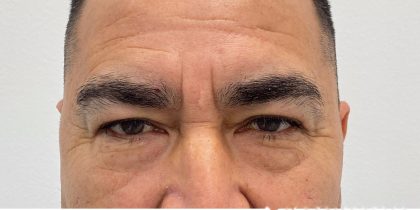 Lower Blepharoplasty Before & After Patient #4232