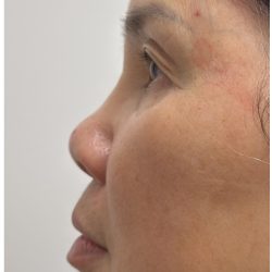Nose Filler Before & After Patient #4212