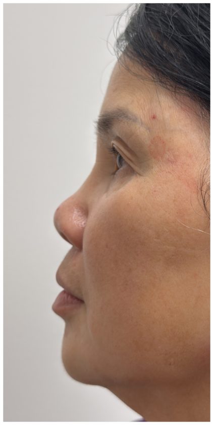 Nose Filler Before & After Patient #4212