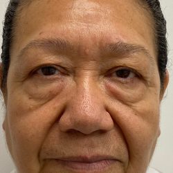 Lower Blepharoplasty Before & After Patient #4230