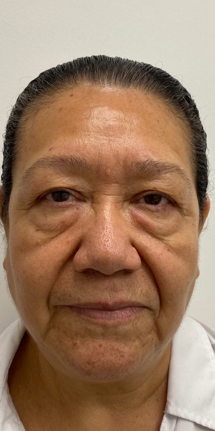 Lower Blepharoplasty Before & After Patient #4230