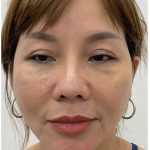 Chin Filler Before & After Patient #4214