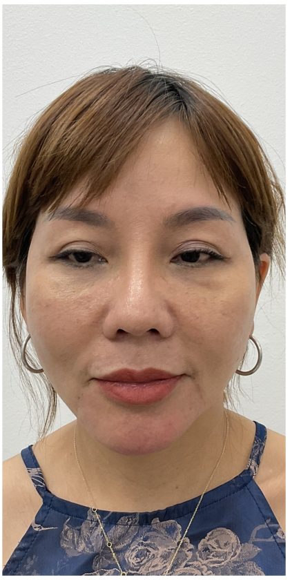 Chin Filler Before & After Patient #4214