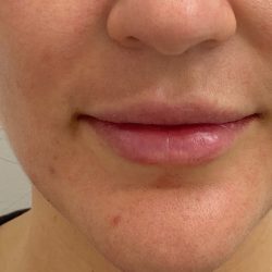 Lip Fillers Before & After Patient #4231