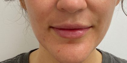 Lip Fillers Before & After Patient #4231