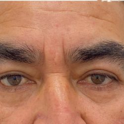 Lower Blepharoplasty Before & After Patient #4232