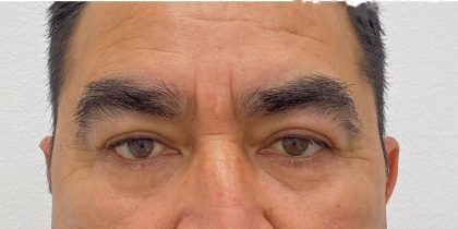 Lower Blepharoplasty Before & After Patient #4232