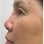 Nose Filler Before & After Patient #4212