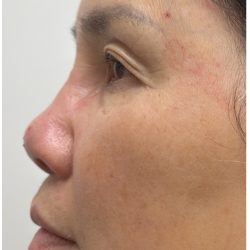 Nose Filler Before & After Patient #4212