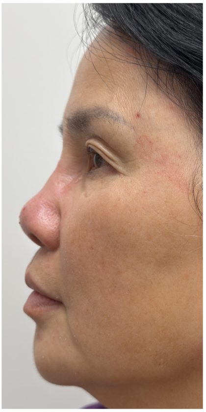 Nose Filler Before & After Patient #4212