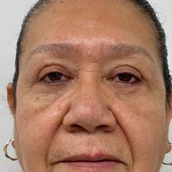 Lower Blepharoplasty Before & After Patient #4230