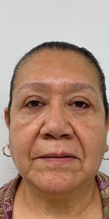 Lower Blepharoplasty Before & After Patient #4230