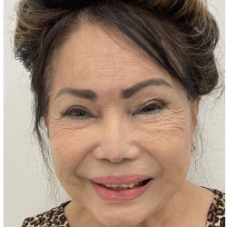 Botox Before & After Patient #4207