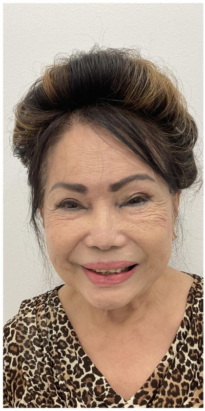 Botox Before & After Patient #4207