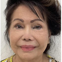 Botox Before & After Patient #4207
