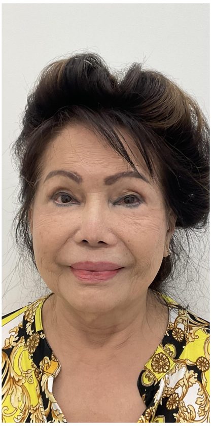 Botox Before & After Patient #4207
